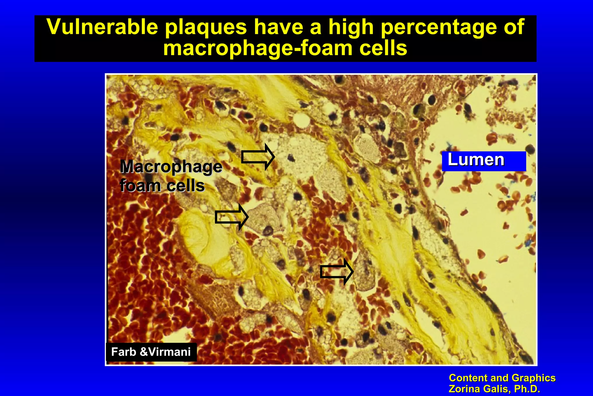 Content and GraphicsContent and Graphics
Zorina Galis, Ph.D.Zorina Galis, Ph.D.
Vulnerable plaques have a high percentage of
macrophage-foam cells
Farb &VirmaniFarb &VirmaniFarb &VirmaniFarb &Virmani
LumenLumenMacrophageMacrophage
foam cellsfoam cells
 