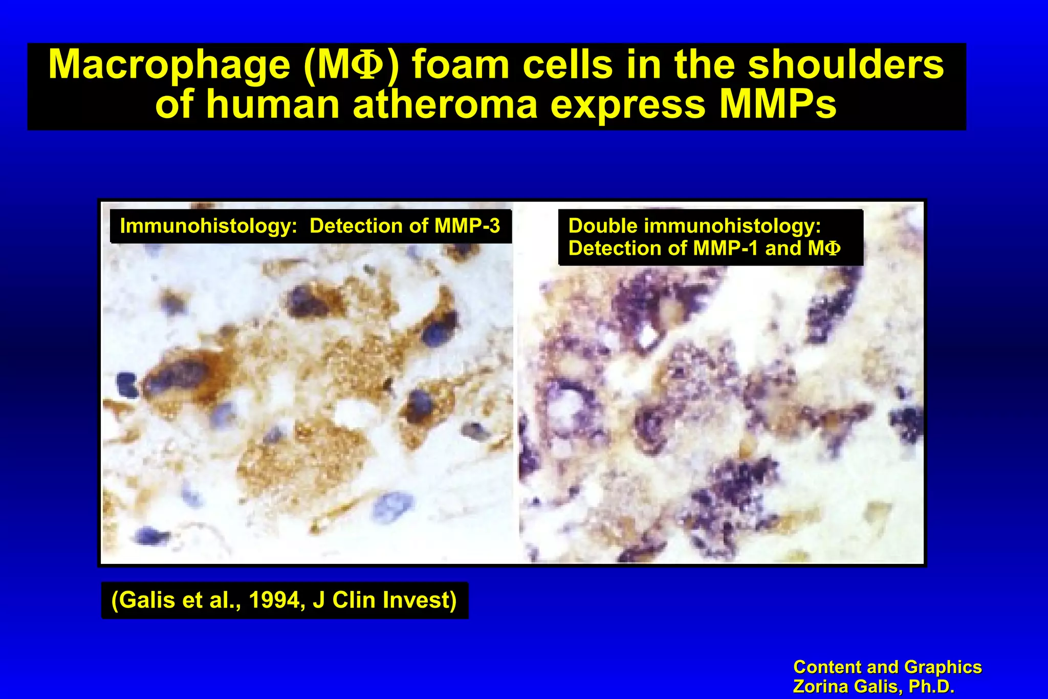 Content and GraphicsContent and Graphics
Zorina Galis, Ph.D.Zorina Galis, Ph.D.
Macrophage (MΦ) foam cells in the shoulders
of human atheroma express MMPs
Immunohistology: Detection of MMP-3Immunohistology: Detection of MMP-3 Double immunohistology:
Detection of MMP-1 and MΦ
Double immunohistology:
Detection of MMP-1 and MΦ
(Galis et al., 1994, J Clin Invest)(Galis et al., 1994, J Clin Invest)
 