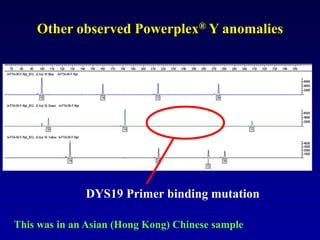 Other observed Powerplex® Y anomalies
DYS19 Primer binding mutation
This was in an Asian (Hong Kong) Chinese sample
 