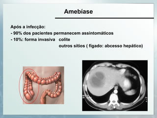 Amebíase
Após a infecção:
- 90% dos pacientes permanecem assintomáticos
- 10%: forma invasiva colite
outros sítios ( fígado: abcesso hepático)
 