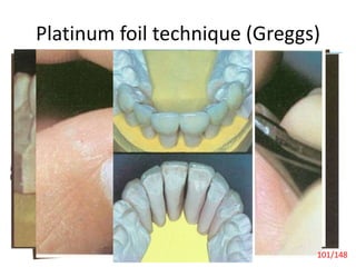 Platinum foil technique (Greggs)
Laminate Veneers 101/148
 