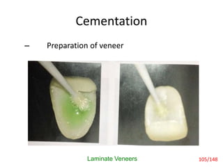 Cementation
Laminate Veneers
– Preparation of veneer
105/148
 