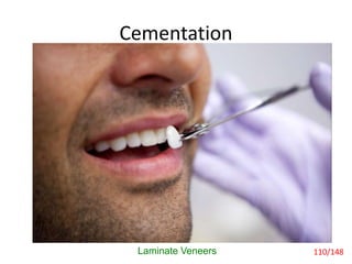 Cementation
Laminate Veneers 110/148
 