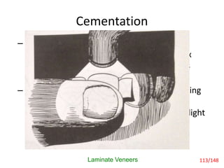 – While maintaining a steady pressure on the
veneer, slightly pull the interproximal matrix
lingually to clear proximal margins of excess
composite.
– With the finger applying pressure and blocking
light to the gingival half of the laminate,
“tack”the veneer in place with a 20 second light
exposure with a wide curing light tip.
Cementation
Laminate Veneers 113/148
 