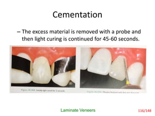 Cementation
Laminate Veneers
– The excess material is removed with a probe and
then light curing is continued for 45-60 seconds.
116/148
 