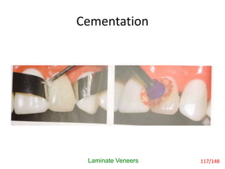 Cementation
Laminate Veneers 117/148
 