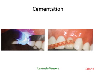 Cementation
Laminate Veneers 118/148
 