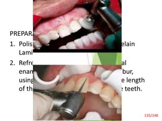 Recent Advances
PREPARATION OF LUMINEERS
1. Polishing Clean the teeth with Porcelain
Laminate Polishing Paste and rinse.
2. Refresh the Enamel Perform minimal
enamelplasty with a prep diamond bur,
using light pressure. –Use the whole length
of the bur, keeping contact with the teeth.
Laminate Veneers 135/148
 