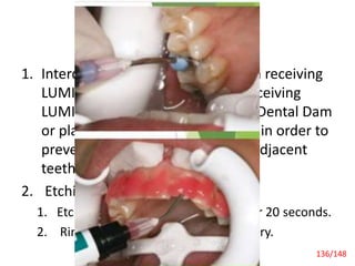 Recent Advances
1. Interdental Strips Isolate the teeth receiving
LUMINEERS from the teeth not receiving
LUMINEERS by applying Paint-On Dental Dam
or placing metal interdental strips in order to
prevent etchant from contacting adjacent
teeth.
2. Etching
1. Etch the teeth with Etch ‘N’ Seal® for 20 seconds.
2. Rinse thoroughly with water, then dry.
Laminate Veneers 136/148
 