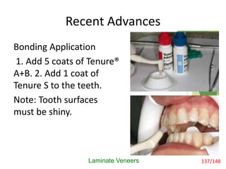 Recent Advances
Bonding Application
1. Add 5 coats of Tenure®
A+B. 2. Add 1 coat of
Tenure S to the teeth.
Note: Tooth surfaces
must be shiny.
Laminate Veneers 137/148
 