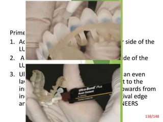 Recent Advances
Prime-Bonding on LUMINEE RS
1. Add 1 coat of Tenure A+B on the inner side of the
LUMINEERS.
2. Add 1 coat of Tenure S on the inner side of the
LUMINEERS.
3. Ultra-Bond® Plus on LUMINEE RS Add an even
layer of Ultra-Bond® Plus resin cement to the
inner side of the LUMINEERS. Work upwards from
incisal edge of the LUMINEERS to gingival edge
and keep light contact with the LUMINEERS
Laminate Veneers 138/148
 