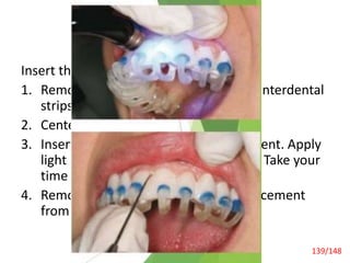 Recent Advances
Insert the LUMITray
1. Remove the Paint-On Dental Dam or interdental
strips.
2. Center the LUMITray (midline).
3. Insert the tray in one smooth movement. Apply
light and continuous buccal pressure. Take your
time for the placement.
4. Remove excess Ultra-Bond Plus resin cement
from the gingiva with a microbrush.
Laminate Veneers 139/148
 
