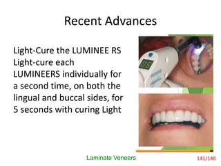 Recent Advances
Light-Cure the LUMINEE RS
Light-cure each
LUMINEERS individually for
a second time, on both the
lingual and buccal sides, for
5 seconds with curing Light
Laminate Veneers 141/148
 