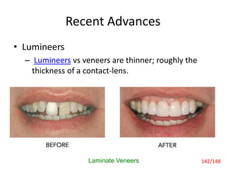 Recent Advances
• Lumineers
– Lumineers vs veneers are thinner; roughly the
thickness of a contact-lens.
Laminate Veneers 142/148
 