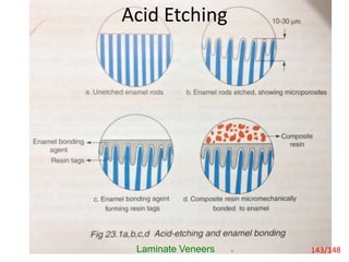 Acid Etching
Laminate Veneers 143/148
 