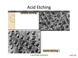 Acid Etching
Laminate Veneers 144/148
 