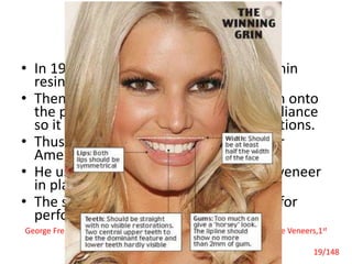 History
• In 1930’s Dr. Charles Pincus first used thin
resin facings.
• Then he baked a thin layer of porcelain onto
the platinum foil and designed the appliance
so it would not interfere with oral functions.
• Thus, created the ‘Hollywood Smile’ for
American Actors.
• He used denture adhesive to hold the veneer
in place.
• The stars could not eat and wore then for
performing only.
Laminate Veneers
George Freedman,Gerald McLaughlin, Colour Atlas of Porcelain Laminate Veneers,1st
edition, 1-244
19/148
 