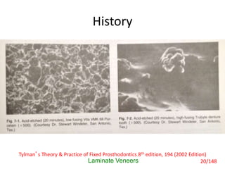 History
• The development of acid-etch technique 30
years ago introduced an aspect of molecular
dentistry known as ‘Bonding’.
• Phosphoric acid applied to tooth enamel
created a surface of microscopic interstices for
mechanical bonding unfilled resin.
Laminate Veneers
Tylman’s Theory & Practice of Fixed Prosthodontics 8th edition, 194 (2002 Edition)
20/148
 