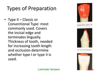 Types of Preparation
• Type II – Classic or
Conventional Type: most
commonly used. Covers
the incisal edge and
terminates lingually.
Thickness of tooth, needed
for increasing tooth length
and occlusion determine
whether type I or type II is
used.
Laminate Veneers 57/148
 