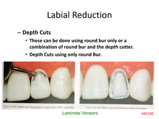 Labial Reduction
– Depth Cuts
• These can be done using round bur only or a
combination of round bur and the depth cutter.
• Depth Cuts using only round Bur.
Laminate Veneers 64/148
 