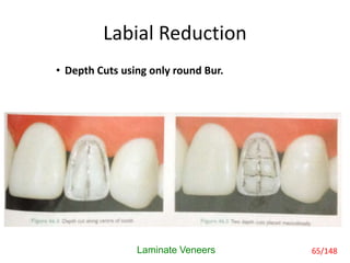 Labial Reduction
• Depth Cuts using only round Bur.
Laminate Veneers 65/148
 