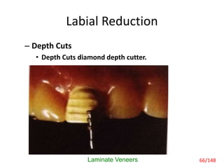 Labial Reduction
– Depth Cuts
• Depth Cuts diamond depth cutter.
Laminate Veneers 66/148
 