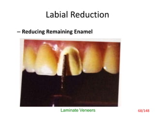 Labial Reduction
– Reducing Remaining Enamel
Laminate Veneers 68/148
 