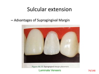 Sulcular extension
– Advantages of Supragingival Margin
Laminate Veneers 74/148
 