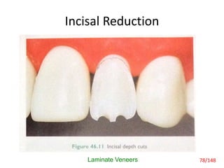 Incisal Reduction
Laminate Veneers 78/148
 