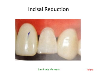 Incisal Reduction
Laminate Veneers 79/148
 