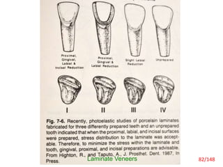 Incisal Reduction
Laminate Veneers 82/148
 