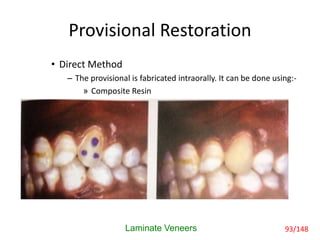 Provisional Restoration
• Direct Method
– The provisional is fabricated intraorally. It can be done using:-
» Composite Resin
Laminate Veneers 93/148
 
