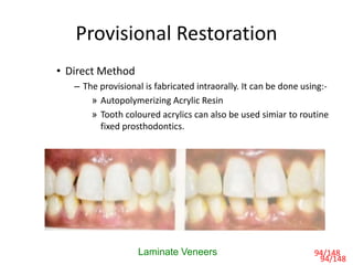 Provisional Restoration
• Direct Method
– The provisional is fabricated intraorally. It can be done using:-
» Autopolymerizing Acrylic Resin
» Tooth coloured acrylics can also be used simiar to routine
fixed prosthodontics.
Laminate Veneers 94/148
94/148
 