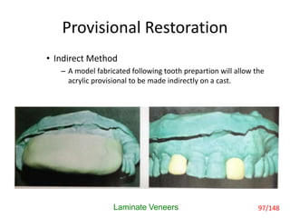 Provisional Restoration
• Indirect Method
– A model fabricated following tooth prepartion will allow the
acrylic provisional to be made indirectly on a cast.
Laminate Veneers 97/148
 