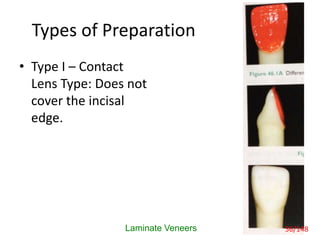 Types of Preparation
• Type I – Contact
Lens Type: Does not
cover the incisal
edge.
Laminate Veneers 56/148
 
