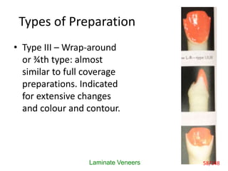 Types of Preparation
• Type III – Wrap-around
or ¾th type: almost
similar to full coverage
preparations. Indicated
for ext...