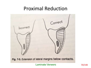 Proximal Reduction
Laminate Veneers 70/148
 