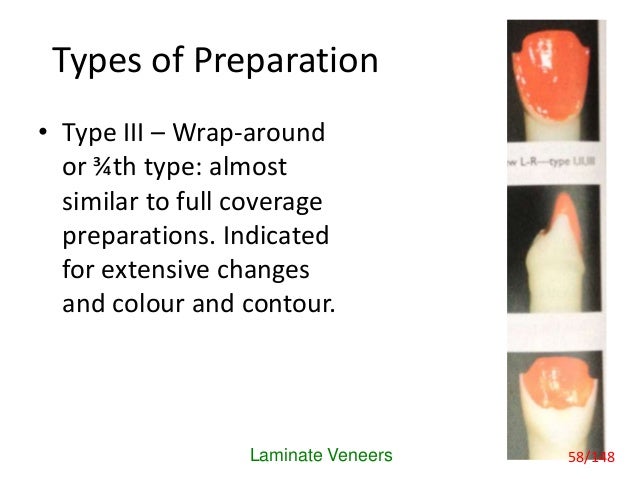 Laminates Veneers