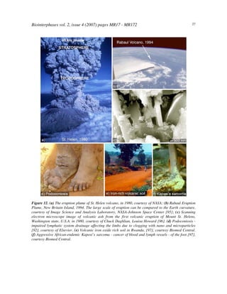 Biointerphases vol. 2, issue 4 (2007) pages MR17 - MR172 27
Figure 12. (a) The eruption plume of St. Helen volcano, in 1980, courtesy of NASA; (b) Rabaul Eruption
Plume, New Britain Island, 1994. The large scale of eruption can be compared to the Earth curvature,
courtesy of Image Science and Analysis Laboratory, NASA-Johnson Space Center [95]; (c) Scanning
electron microscope image of volcanic ash from the first volcanic eruption of Mount St. Helens,
Washington state, U.S.A. in 1980, courtesy of Chuck Daghlian, Louisa Howard [96]. (d) Podoconiosis -
impaired lymphatic system drainage affecting the limbs due to clogging with nano and microparticles
[92], courtesy of Elsevier. (e) Volcanic iron oxide rich soil in Rwanda, [97], courtesy Biomed Central.
(f) Aggressive African-endemic Kaposi’s sarcoma - cancer of blood and lymph vessels - of the foot [97],
courtesy Biomed Central.
 