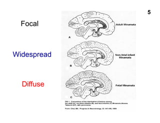 Focal
Widespread
Diffuse
5
 