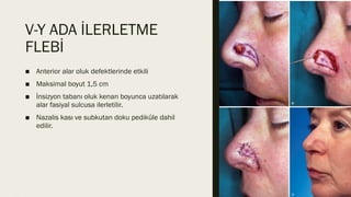 Yüzde lokal flepler (local flaps in facial plastic surgery) | PPTX