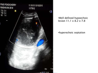 •Well defined hypoechoic
lesion 11.1 x 8.2 x 7.8
•hyperechoic septation
 