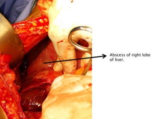 Abscess of right lobe
of liver.
 