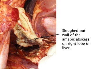 Sloughed out
wall of the
amebic abscess
on right lobe of
liver.
 