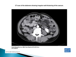 CT scan of the abdomen showing irregular wall thickening of the caecum.
Vinoth Boopathy et al. BMJ Case Reports 2014;2014:bcr-
2013-202616
©2014 by BMJ Publishing Group Ltd
 