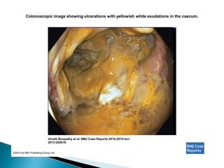 Colonoscopic image showing ulcerations with yellowish white exudations in the caecum.
Vinoth Boopathy et al. BMJ Case Reports 2014;2014:bcr-
2013-202616
©2014 by BMJ Publishing Group Ltd
 