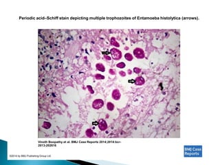 Periodic acid–Schiff stain depicting multiple trophozoites of Entamoeba histolytica (arrows).
Vinoth Boopathy et al. BMJ Case Reports 2014;2014:bcr-
2013-202616
©2014 by BMJ Publishing Group Ltd
 