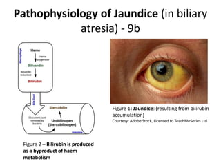 Pathophysiology of Jaundice (in biliary
atresia) - 9b
Figure 1: Jaundice: (resulting from bilirubin
accumulation)
Courtesy: Adobe Stock, Licensed to TeachMeSeries Ltd
Figure 2 – Bilirubin is produced
as a byproduct of haem
metabolism
 