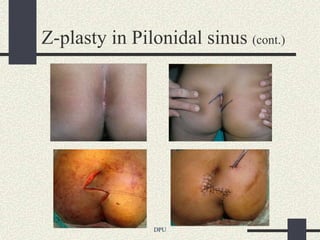 Z-plasty in Pilonidal sinus (cont.)




                DPU
 