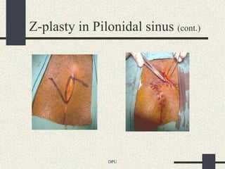 Z-plasty in Pilonidal sinus (cont.)




                DPU
 